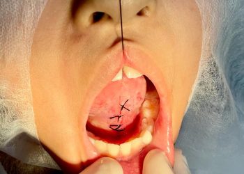 Odontopediatria: Patos oferece cirurgia gratuita de frenectomia para crianças de 0 a 14 anos