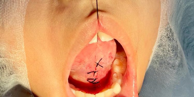 Odontopediatria: Patos oferece cirurgia gratuita de frenectomia para crianças de 0 a 14 anos