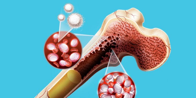 Mieloma múltiplo: cinco fatos que você precisa saber sobre esse tipo de câncer hematológico