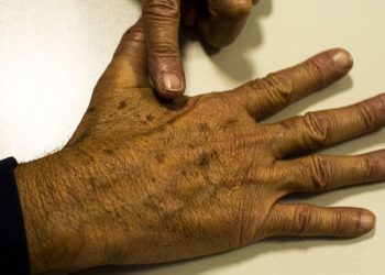 Tecnologia para tratar câncer de pele é aprovado para uso no SUS