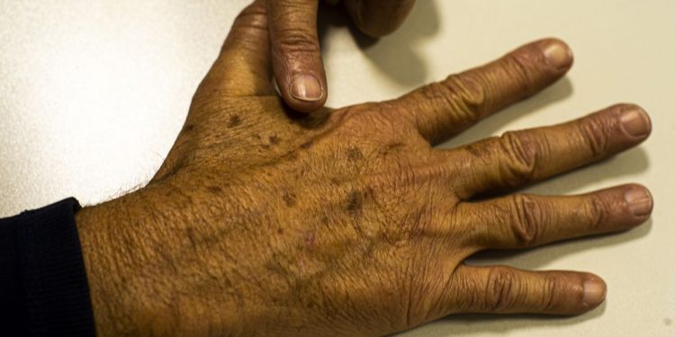 Tecnologia para tratar câncer de pele é aprovado para uso no SUS