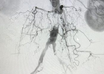Serviço de Hemodinâmica em Campina Grande realiza procedimento de alta complexidade para tratamento de obstrução da aorta