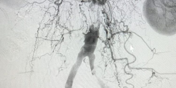 Serviço de Hemodinâmica em Campina Grande realiza procedimento de alta complexidade para tratamento de obstrução da aorta