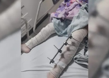 Médicos fazem cirurgia em perna errada de menina de 6 anos, em Campina Grande