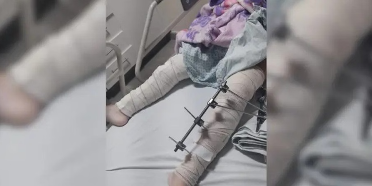 Médicos fazem cirurgia em perna errada de menina de 6 anos, em Campina Grande