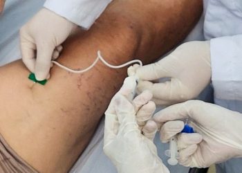 Hospital Edson Ramalho realiza procedimento vascular com aplicação de espumas para tratamento de varizes