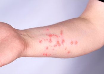 Casos de mpox no Brasil este ano já superam o total de 2023