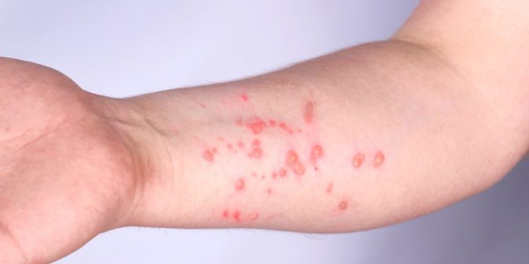 Casos de mpox no Brasil este ano já superam o total de 2023