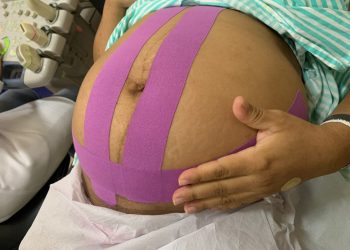 Maternidade Frei Damião oferece taping para pacientes e garante mais conforto na gestação e pós-operatório