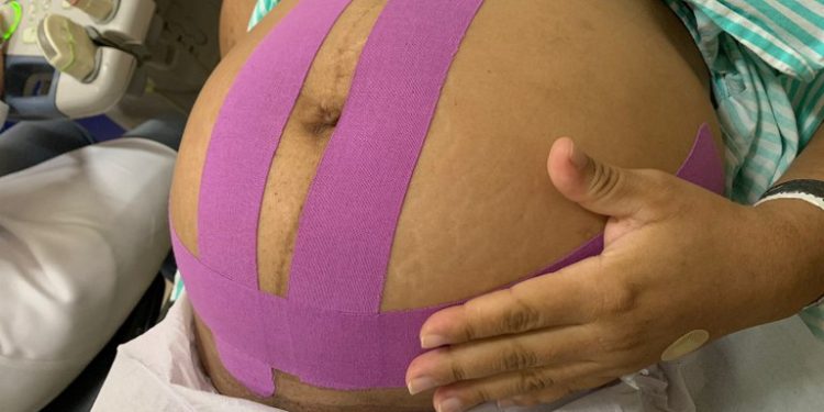 Maternidade Frei Damião oferece taping para pacientes e garante mais conforto na gestação e pós-operatório